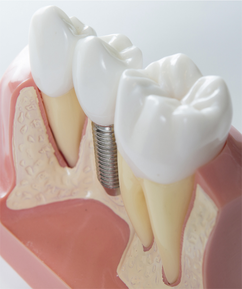 implante dental clinica dental chile, logroño
