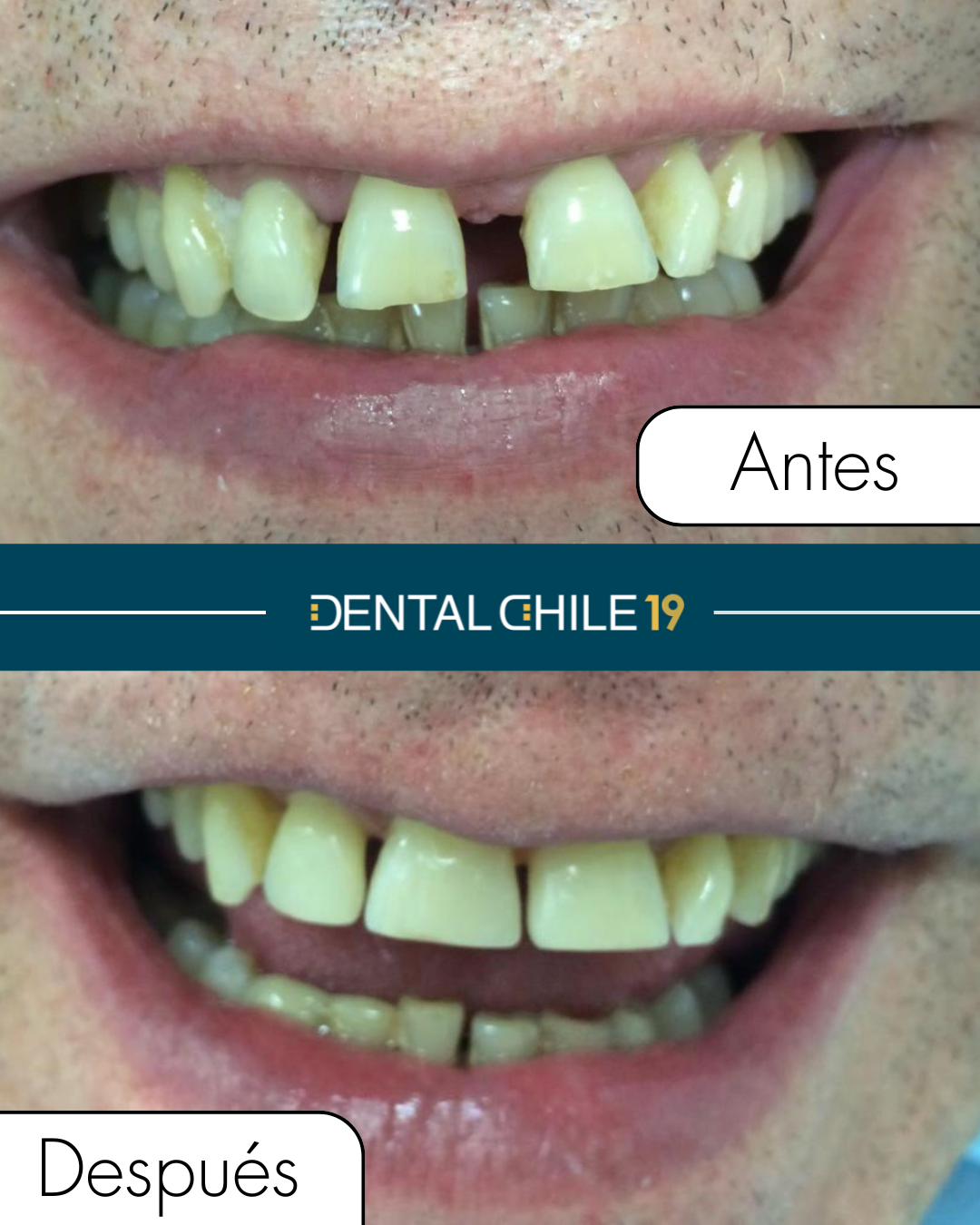 Cierre de espacios dentales sin tallado