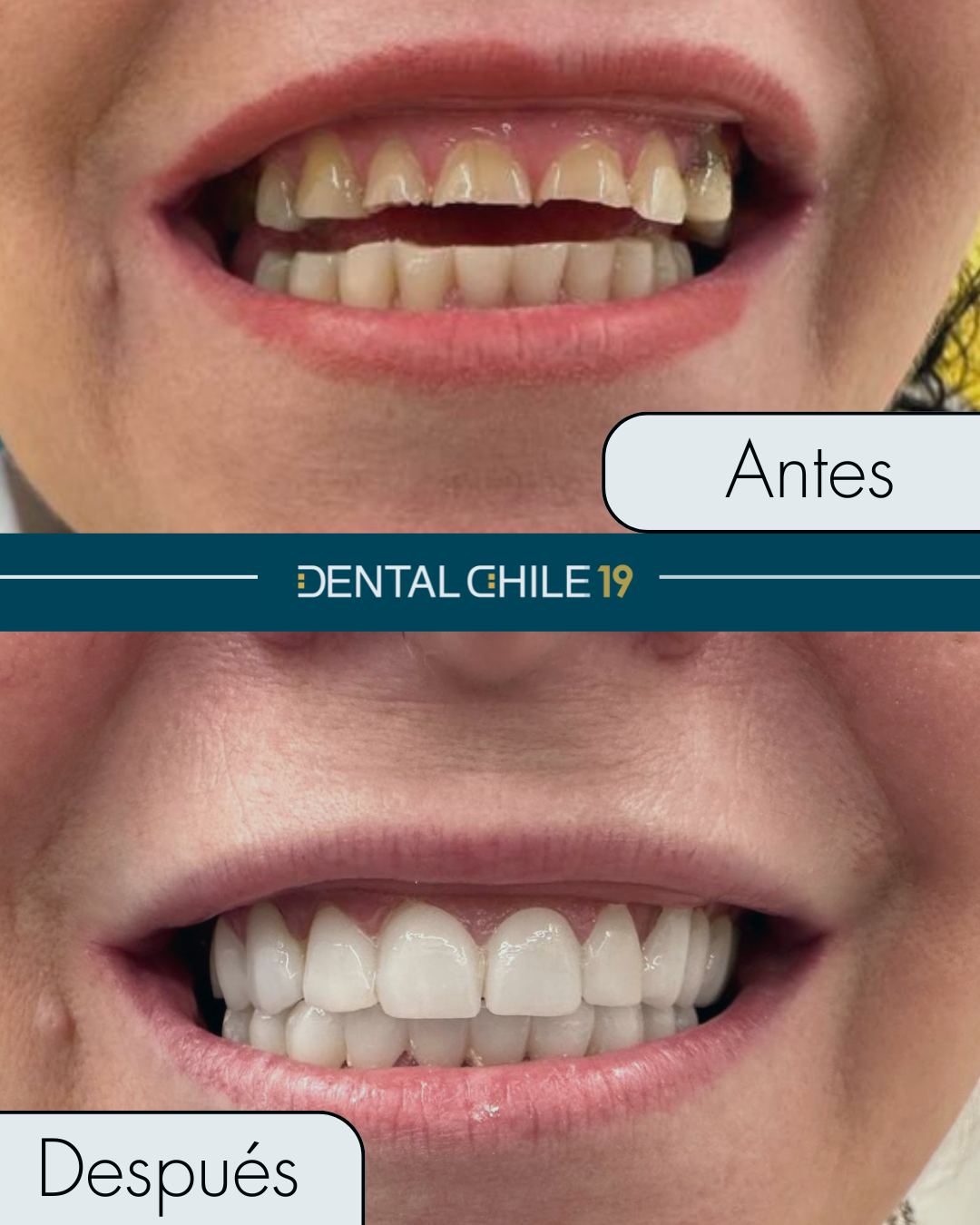 Coronas de circonio. Clínica Dental Chile19 Logroño